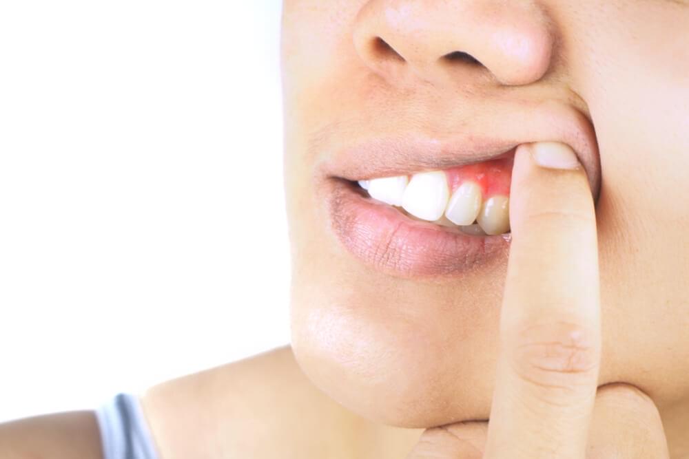 What Is Gum Recession? | Lincoln Dental Center