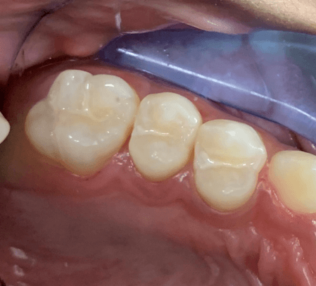 Cavities After | Lincoln Dental Center