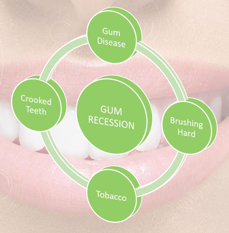 What Is Gum Recession Diagram | Lincoln Dental Center
