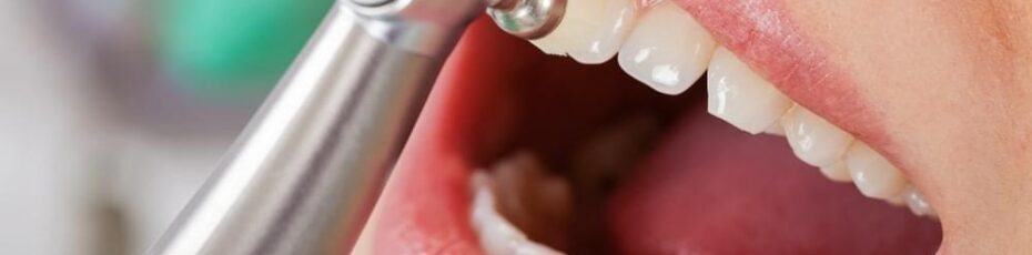 Does Professional Teeth Cleaning have any side effects?