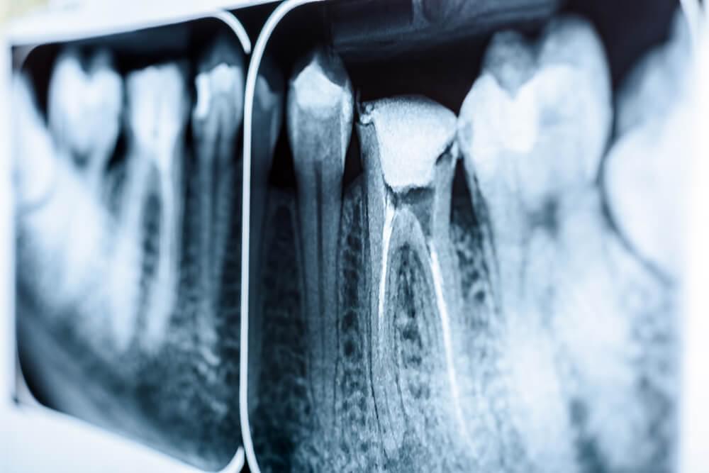 Does your tooth need a root canal treatment?