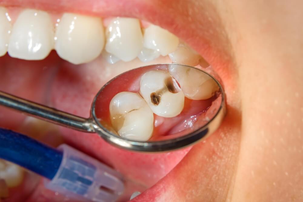 How Effective Are Fissure Sealants To Prevent Cavities in Children?